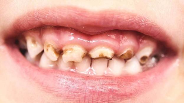 The adverse effects of white chocolate on kids’ teeth: